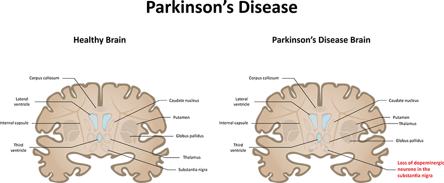 Comparison between healthy brain and brain inflicted with Parkinson's Disease