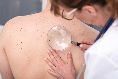 Skin Cancer Detection and Prevention